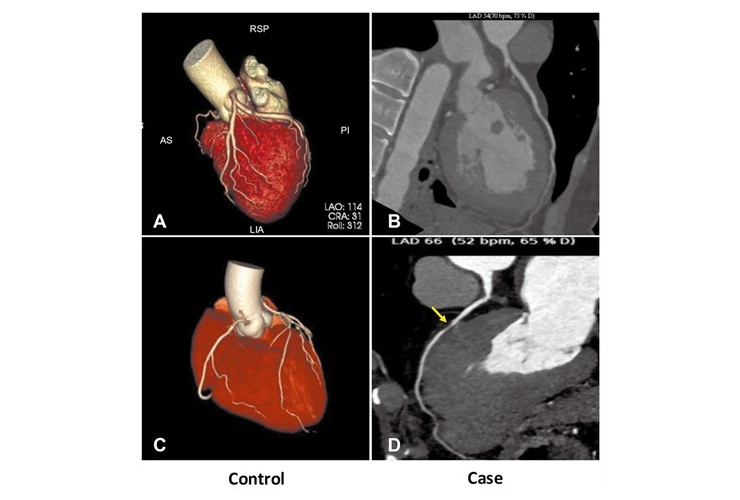 Image: Patients without pre-existing CAS (A, B) are at higher risk of adverse effects from acute PE than CAS patients (C, D) (Photo courtesy of Zhi-Cheng Jing/Chinese Medical Journal)